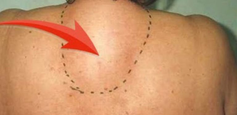Jednoduchý prostředek, který odstraní soli z krční páteře a zmírní osteochondrózu!
