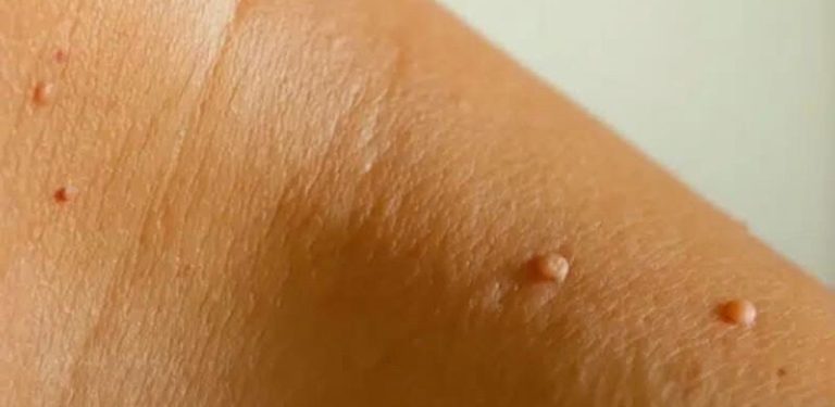 Proč se mi na krku nebo v podpaží objevují mateřská znaménka tělové barvy a jak se jich zbavit? Odborníci vysvětlují.