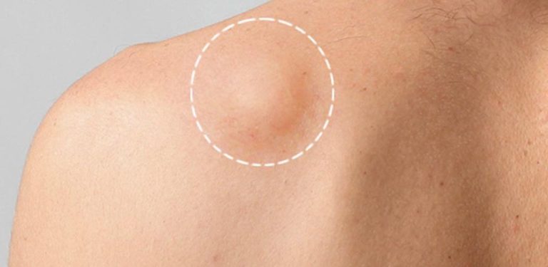 Přirozené odstranění tukové tkáně (lipomu) pomocí tohoto jednoduchého receptu