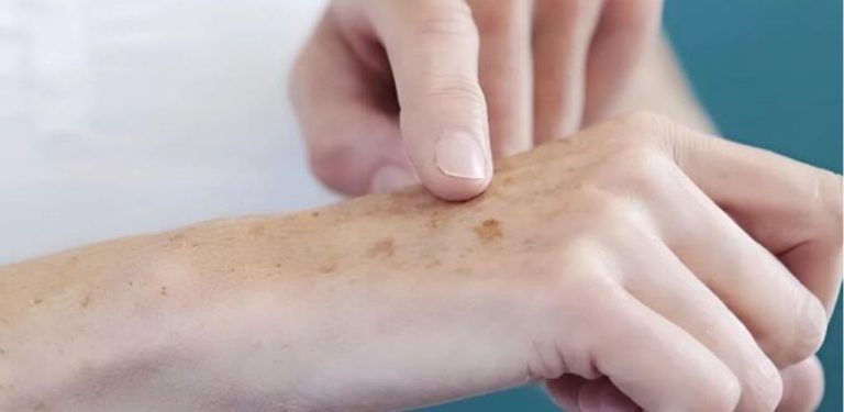 Můj přítel dermatolog mi doporučil tento produkt a já jsem odstranil své stařecké skvrny pomocí levné kuchyňské ingredience.