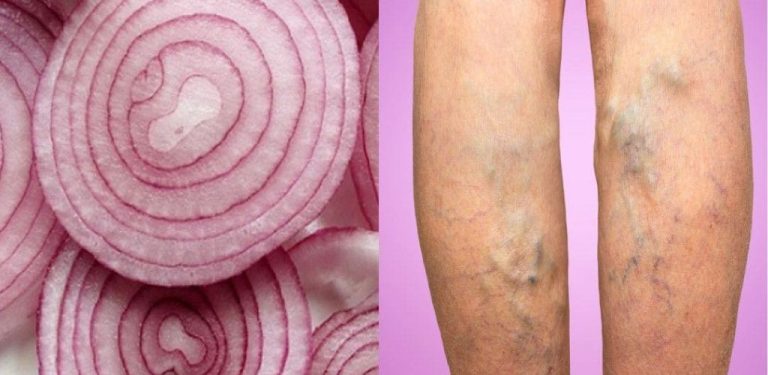Červená cibule může vyléčit křečové žíly! Jak připravit přírodní lék, který přináší senzační výsledky…