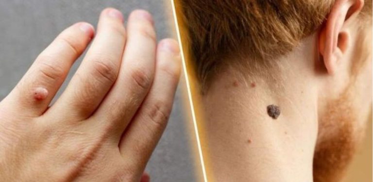 Jak odstranit kožní výrůstky a bradavice přes noc – přírodní způsob, který funguje