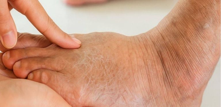 Diabetická noha: příčiny, příznaky a účinná léčba