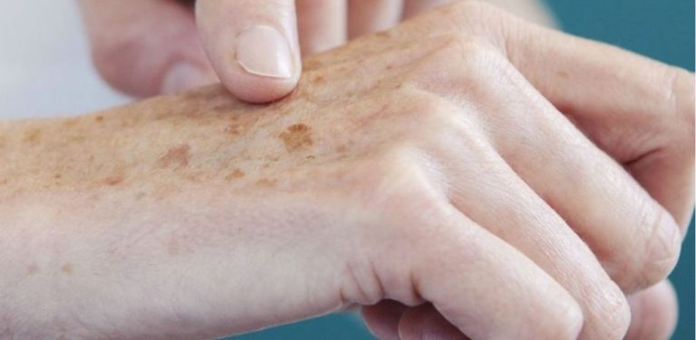 Zbavte se SKVRN a VRÁSK na RUKOU pomocí těchto 2 ingrediencí, které máme doma