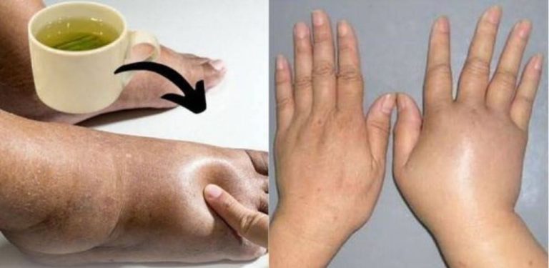 Vypijte tento čaj a už nikdy nebudete mít oteklé nohy, kotníky nebo chodidla.