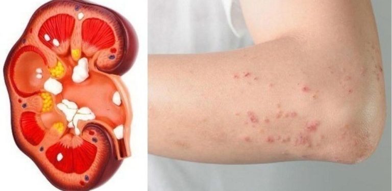 8 varovných signálů, že vaše ledviny mají potíže