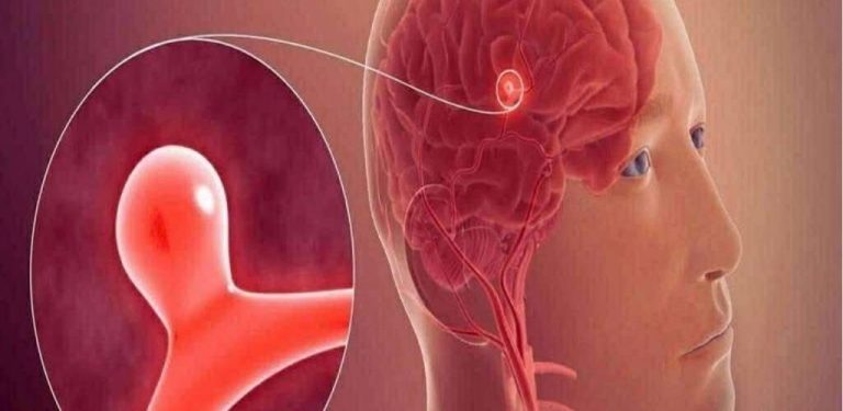 Aneuryzma: příznaky, které byste neměli ignorovat…