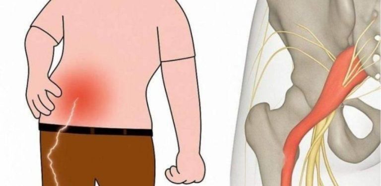 3 jednoduché techniky, jak ulevit od ischiasu v noze: prakticky a efektivně