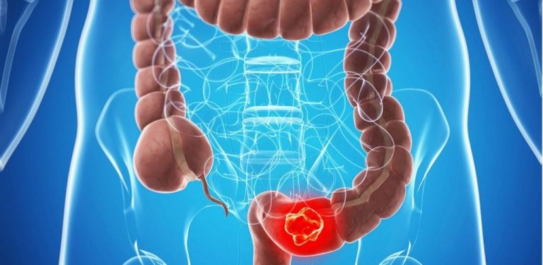 Nárůst počtu případů rakoviny tlustého střeva. Lékaři varují, že za to mohou některé druhy ovoce a zeleniny. Staré léky na ochranu střev a prevenci