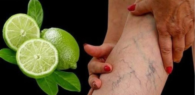 Síla citronů pro přirozené snížení křečových žil