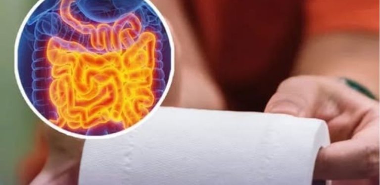 Vzhledem k rostoucímu počtu případů rakoviny tlustého střeva u mladých lidí varují praktičtí lékaři před nejčastěji přehlíženými příznaky.