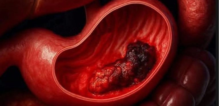Věděli jste, že rakovina žaludku může začínat tak nepatrnými příznaky, že je většina lidí přehlédne?