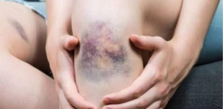 Modřiny na těle bez úrazu: Příčiny, kdy se obávat a kdy vyhledat lékaře