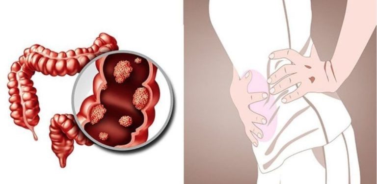 Rakovina tlustého střeva: 4 příznaky, které byste neměli ignorovat