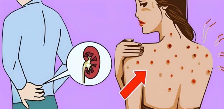 Pokud vaše ledviny nefungují správně, tělo vám to dá najevo těmito 10 příznaky