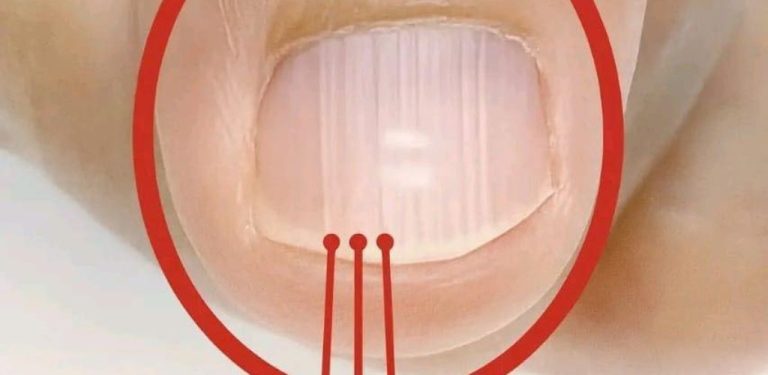 Pokud se vám po 40. roce věku začnou na nehtech objevovat rýhy, může to být varovný signál…