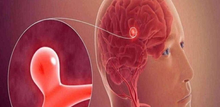 12 příznaků, které mohou naznačovat mozkové aneurysma – neignorujte je!