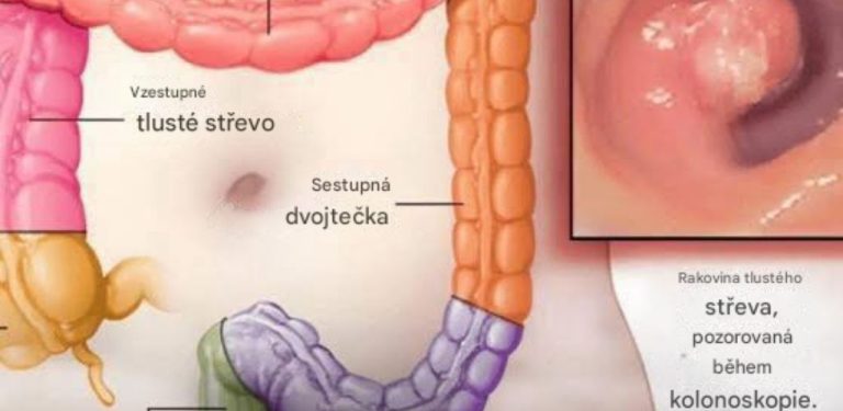 Pokud si při návštěvě toalety všimnete těchto 7 příznaků, měli byste okamžitě vyhledat lékaře.