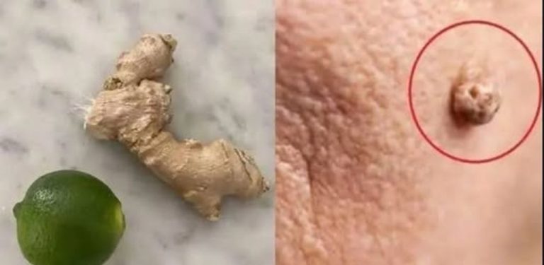 Bradavice odpadávají jako listí, když tuto léčbu jednoduše aplikujete doma…
