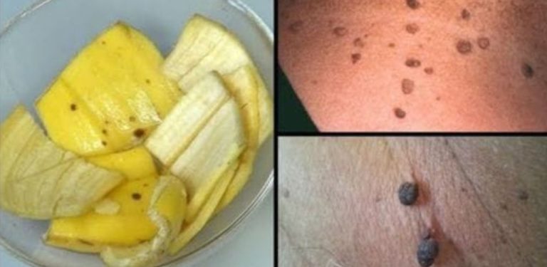 Jak se zbavit skvrn na kůži: metoda s banány a jablečným octem