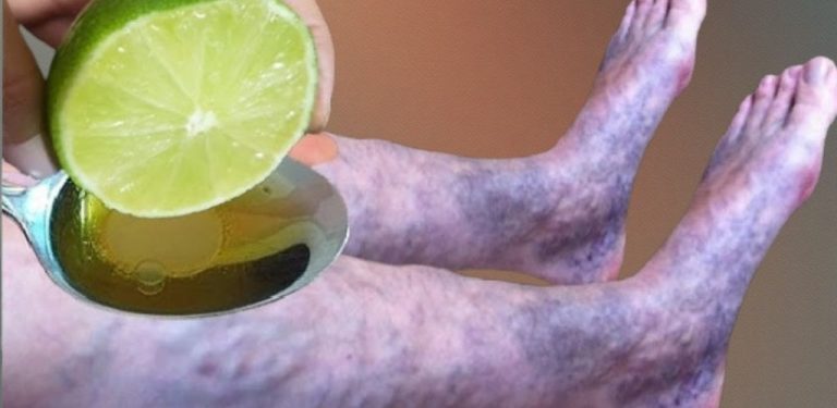 Moje babička léčila křečové žíly pouze třemi ingrediencemi…