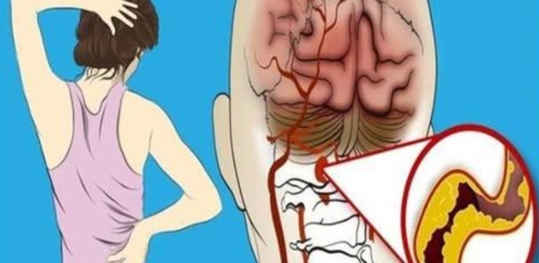 Jak rozpoznat časné příznaky a symptomy cévní mozkové příhody