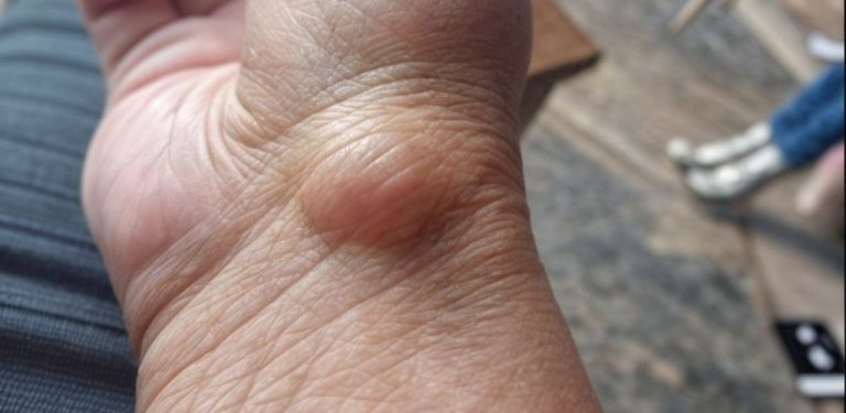 Ganglion (tzv. „vlčí dráp“) – co to je, proč vzniká a kdy zbystřit
