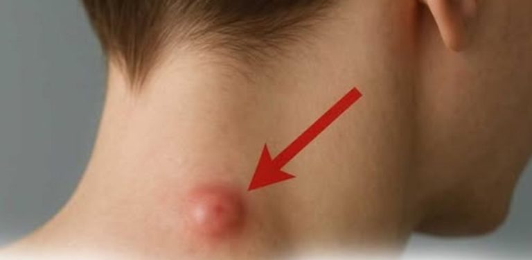 Objevili jste bulku na krku, zádech nebo za uchem? Co může znamenat a kdy zbystřit