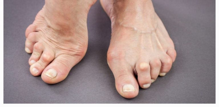 Přírodní prostředky proti kyselině močové a dně