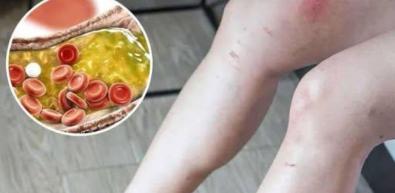 Jak mohou vaše nohy signalizovat srdeční potíže a ucpané tepny